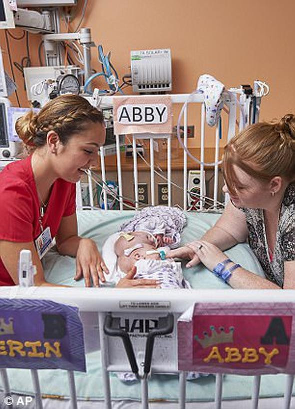 Dünya merakla bekliyordu yapışık ikizler ameliyat oldu - Resim: 3