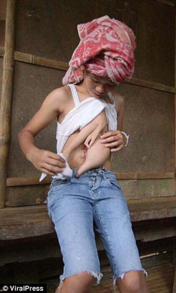 Göğsünde iki kol ile doğdu  şimdi tedavi olmayı bekliyor - Resim: 2