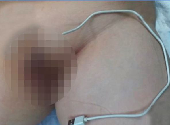 Cinsel organına USB kablosu sıkıştı! Bu kadarına pes - Resim: 2