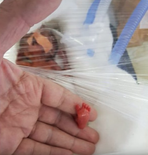 400 gram doğdu ayağındaki o detay her şeyi değiştirdi - Resim: 2