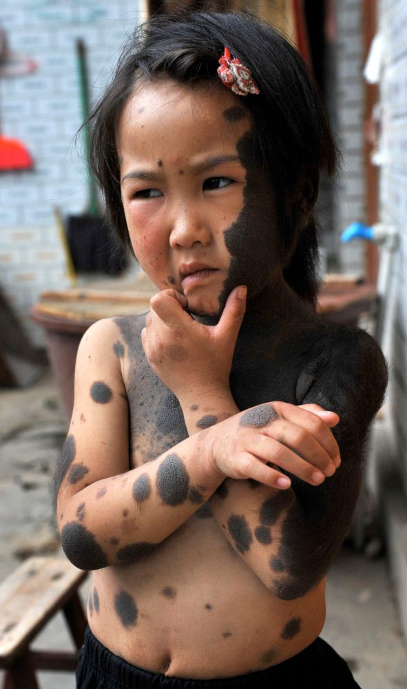 Kurt kızın dramı - Resim: 4