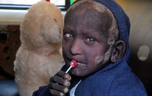 Küçük çocuk gün geçtikçe taşa dönüyor! - Resim: 4