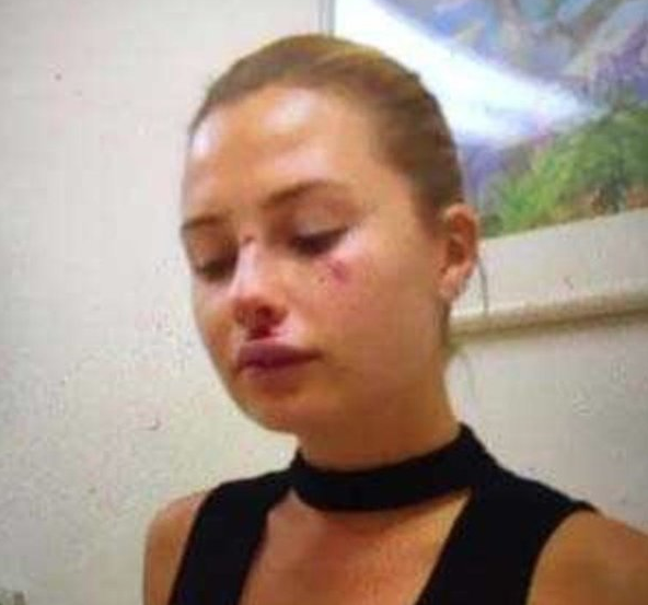 Serdar Ortaç'ın eşi Chloe ölümden döndü! Kolu kırıldı kalçası çatladı - Resim: 1