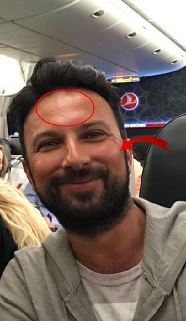Tarkan'ın estetik sonrası ilk görüntüsü - Resim: 3