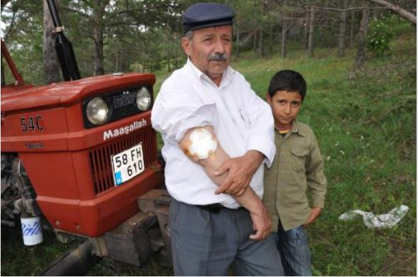 15 yıl kolundaki bezle yaşadı - Resim: 3