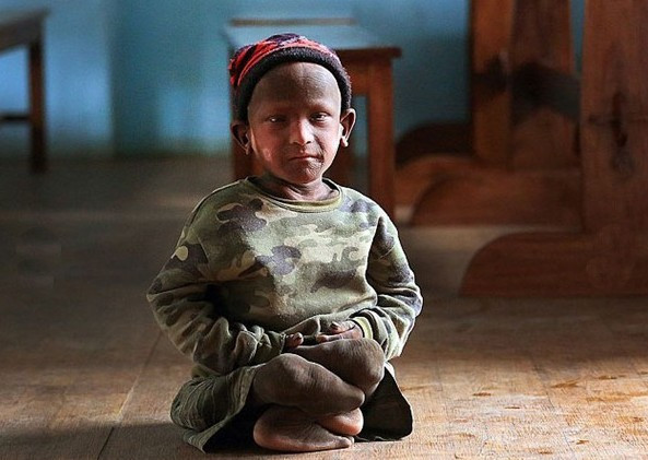 Küçük çocuk gün geçtikçe taşa dönüyor! - Resim: 2