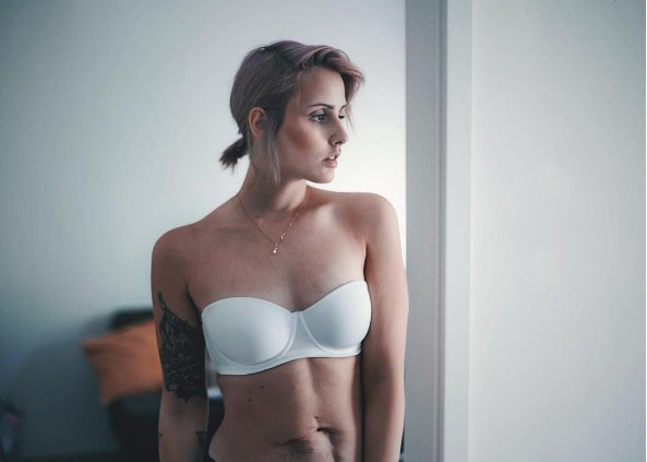 16 yaşındayken bağırsakları alındı 7 yıl sonra ise... - Resim: 2