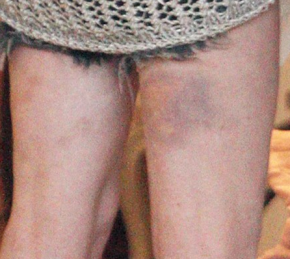 Ünlü güzelin her tarafı mosmor!  - Resim: 4