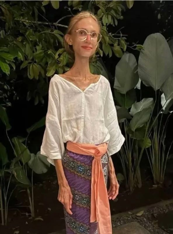 22 kiloya kadar düşmüştü! Sosyal medya fenomeni kaldığı otelde hayatını kaybetti - Resim: 4