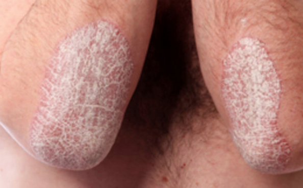 Sedef hastalığı nedir tedavisi var mıdır? - Resim: 2