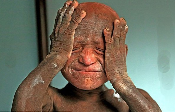 Küçük çocuk gün geçtikçe taşa dönüyor! - Resim: 1