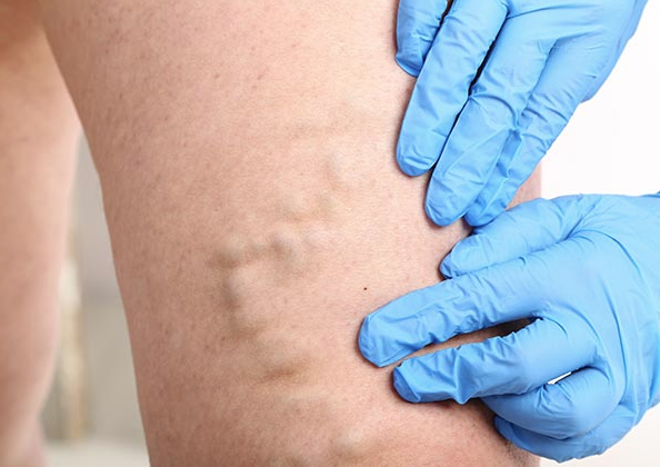 Bacak bacak üstüne atarak oturmayın! Varis tehlikesi... - Resim: 1