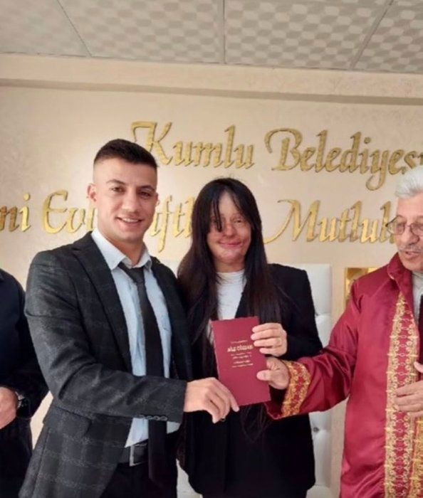 Yüzünü yakan kişiyle evlenen Berfin Özek herkesi şoke etti! Babası konuştu: Nasıl yapar bunu? - Resim: 3
