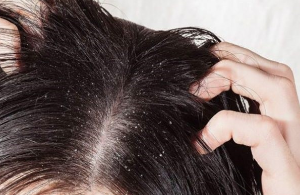 Saçınızdaki kepeklerden kurtulmanın sırları - Resim: 2