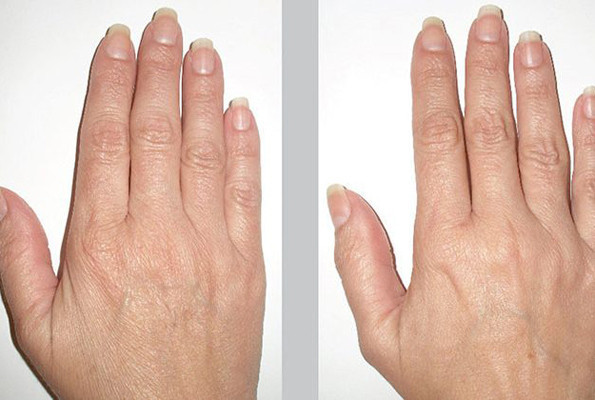 Burun, meme derken şimdi de el estetiği revaçta - Resim: 1