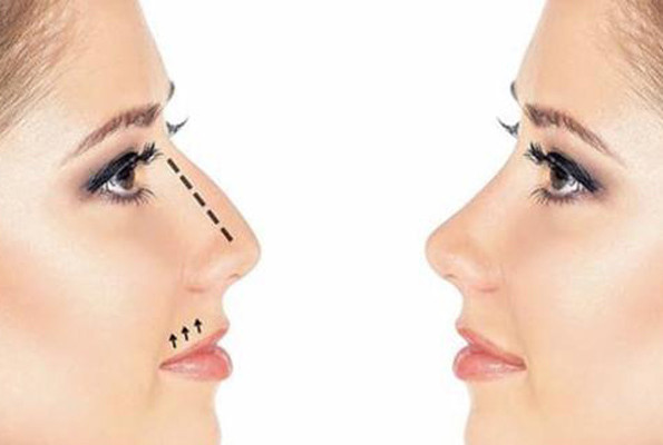 Burun, meme derken şimdi de el estetiği revaçta - Resim: 3