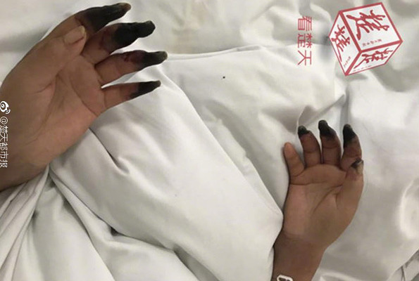 Küçük yara deyip önemsemedi parmaklarının kesilmesi ile karşı karşıya kaldı - Resim: 1