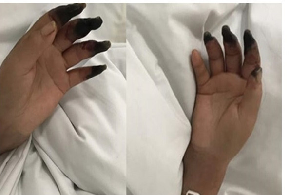 Küçük yara deyip önemsemedi parmaklarının kesilmesi ile karşı karşıya kaldı - Resim: 2