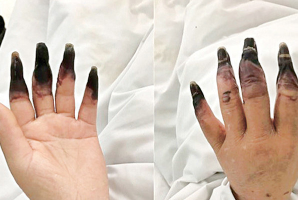 Küçük yara deyip önemsemedi parmaklarının kesilmesi ile karşı karşıya kaldı - Resim: 3