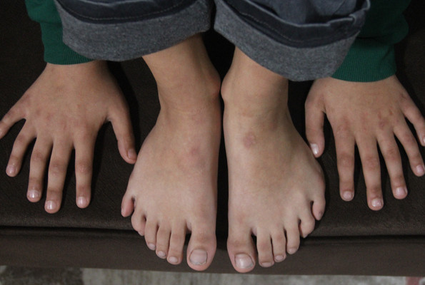 Adana'da yaşıyor 9 yaşındaki Demirhan'ın tam 24 parmağı bulunuyor - Resim: 2