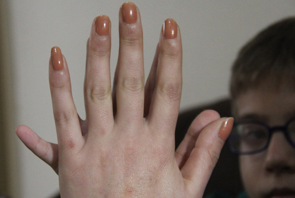 Adana'da yaşıyor 9 yaşındaki Demirhan'ın tam 24 parmağı bulunuyor - Resim: 4