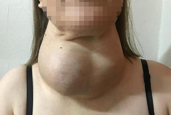 Ameliyattan korktu dev guatr ile 30 yıl yaşadı - Resim: 1