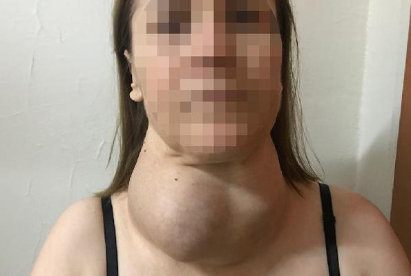 Ameliyattan korktu dev guatr ile 30 yıl yaşadı - Resim: 3