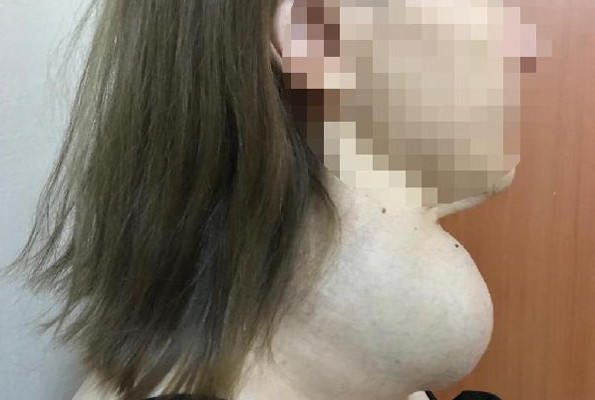 Ameliyattan korktu dev guatr ile 30 yıl yaşadı - Resim: 4