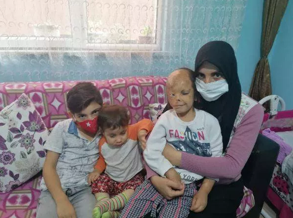 Kocaeli'de yüzü yanan minik Dilara için Sağlık Bakanlığı devreye girdi - Resim: 0