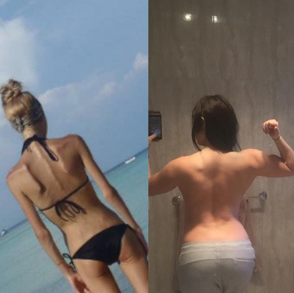 Anoreksiyadan kurtulan genç kızın mucizevi değişimi - Resim: 4