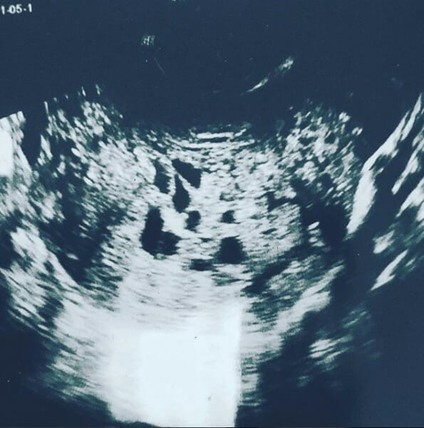 Hamile olduğunu zannediyordu doğurduğu şeyi görenler şoke oldu - Resim: 2