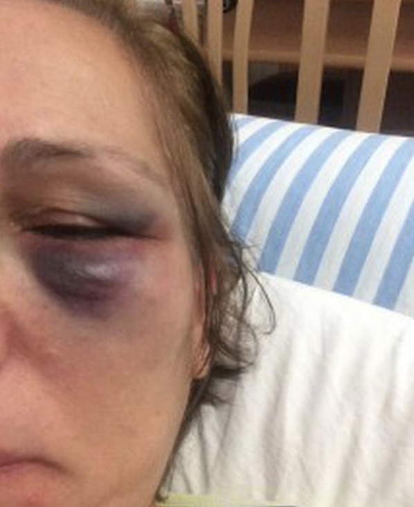 Sokak hayvanlarını besliyor diye gözünü morarttılar! - Resim: 3