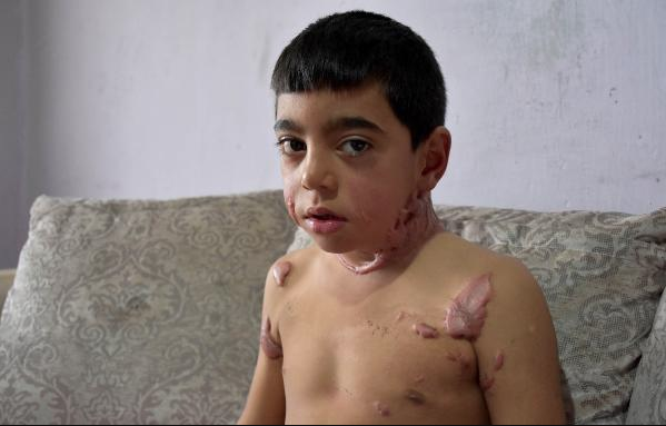 Vücudundaki yanıklardan utanan minik Siraç okulu bıraktı yardım bekliyor - Resim: 2