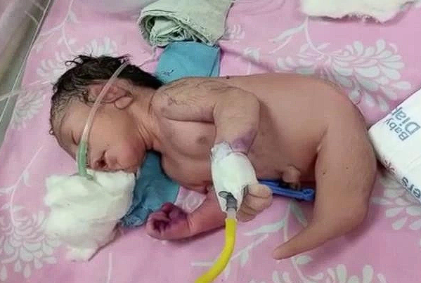 Boynuzla dünyaya geldi! Ayakları olmayan bebek şaşkına uğrattı - Resim: 0