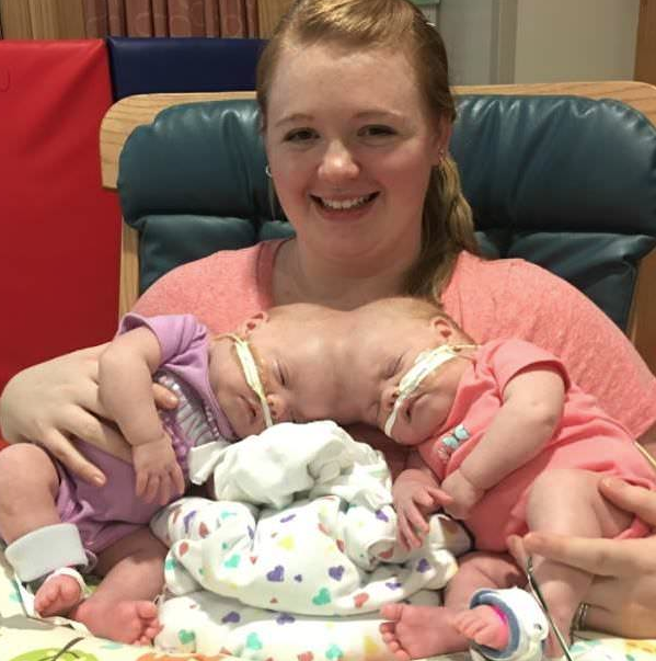 Bu halde doğdular doktorları bile şaşkına çevirdiler daha sonra da ... - Resim: 1