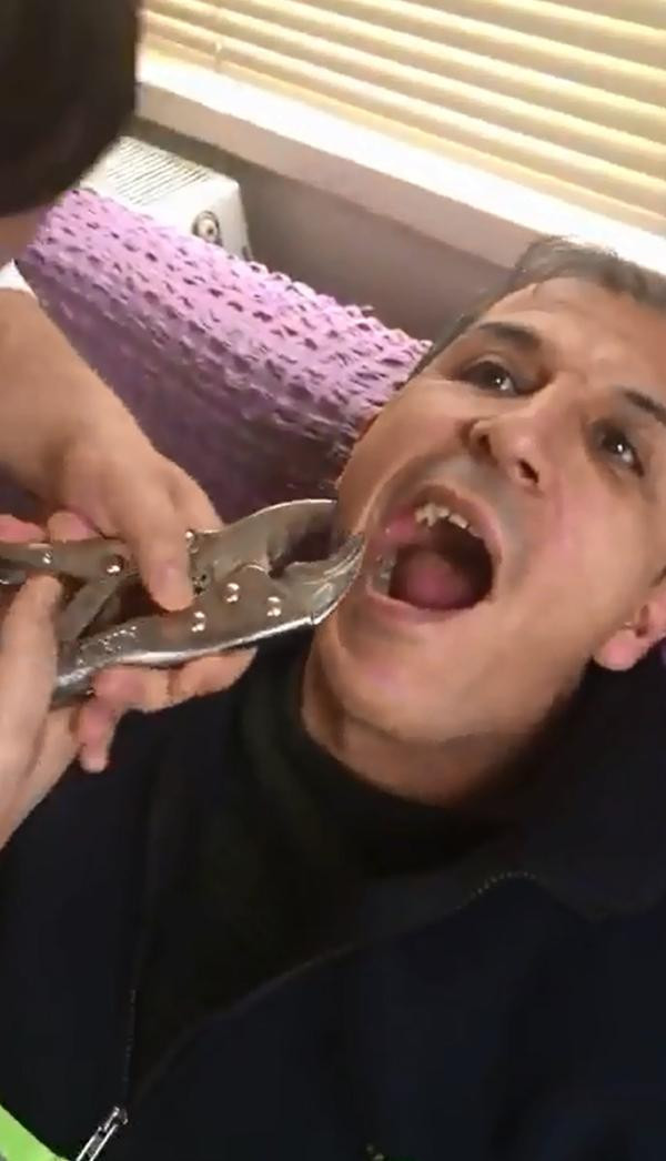 Bu video rekor kırıyor çürüyen dişini penseyle çektirdi! - Resim: 1