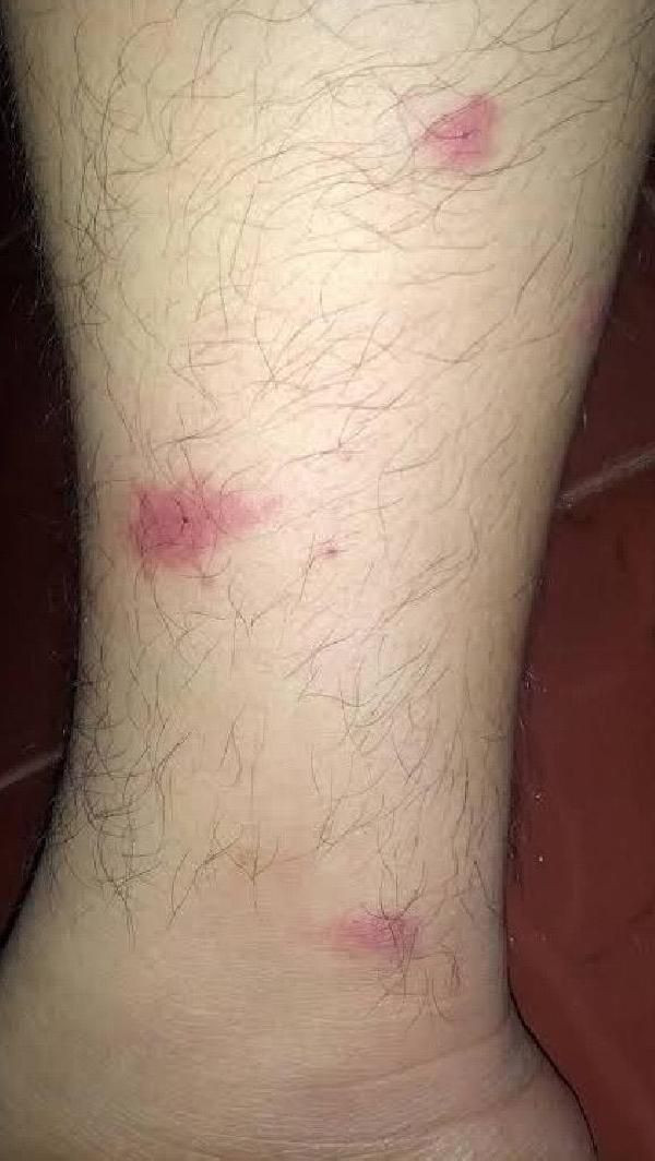 Sapanca'da Asya kaplan sivrisineği paniği yaşanıyor! Her yerdeler - Resim: 3