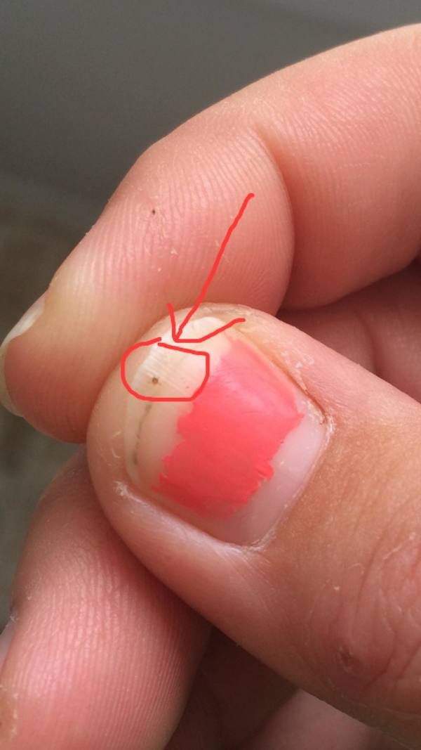 Kızının tırnağında siyah bir nokta fark etti hemen hastaneye koştu - Resim: 3