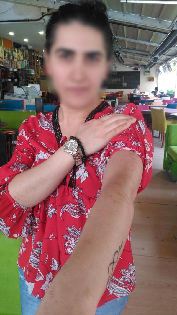 Dövülmedi! Yaptırdığı lazer epilasyon bu hale getirdi - Resim: 2