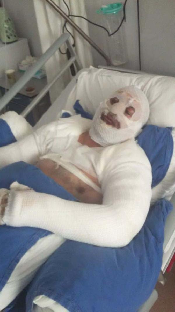 Saç kurutma makinesini çalıştırdı, patlamada bu hale geldi - Resim: 1