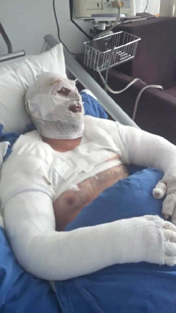 Saç kurutma makinesini çalıştırdı, patlamada bu hale geldi - Resim: 2