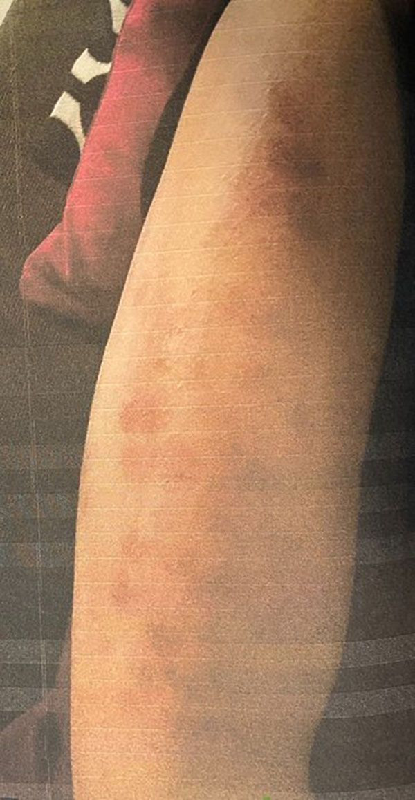 Ünlü şair Ahmet Selçuk İlkan'ın kızlarını yaktılar! Lazer kurbanı kardeşler mahkemeye koştu - Resim: 4