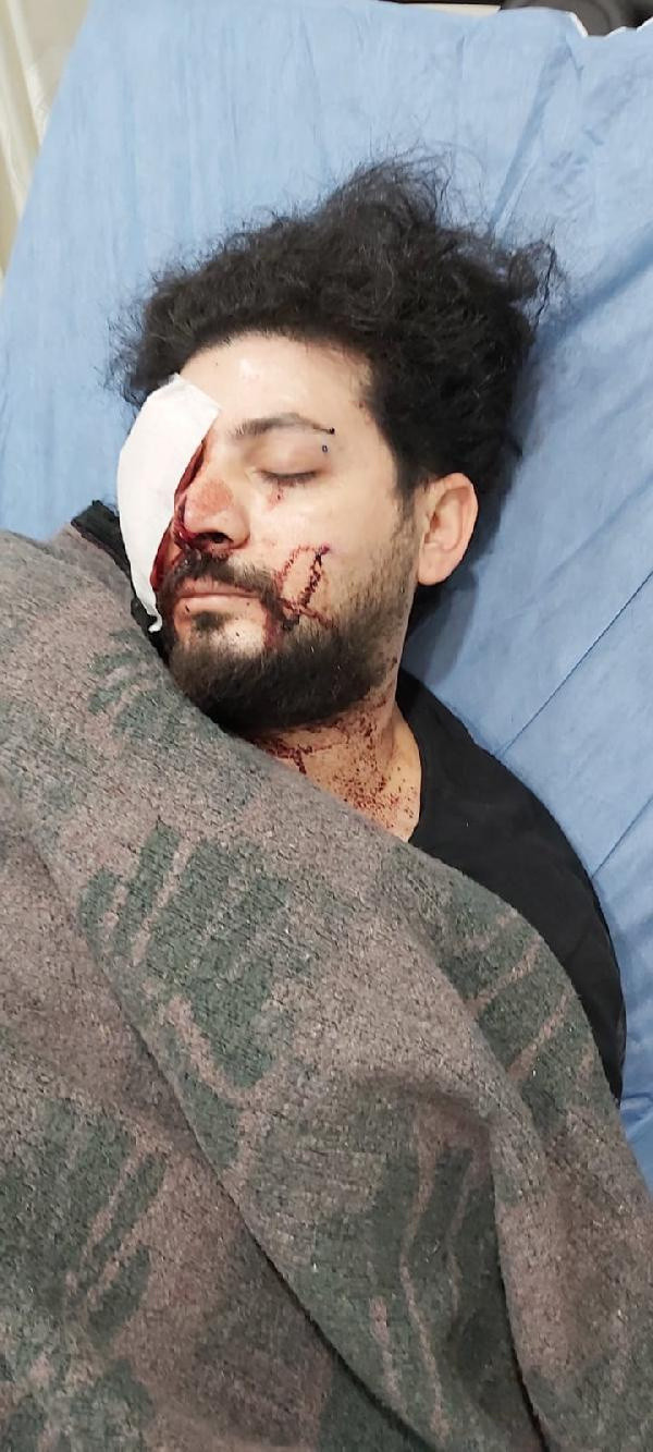 Maganda kuruşunuyla gözünü kaybeden Şahan Dinç dehşet anlarını anlattı - Resim: 2