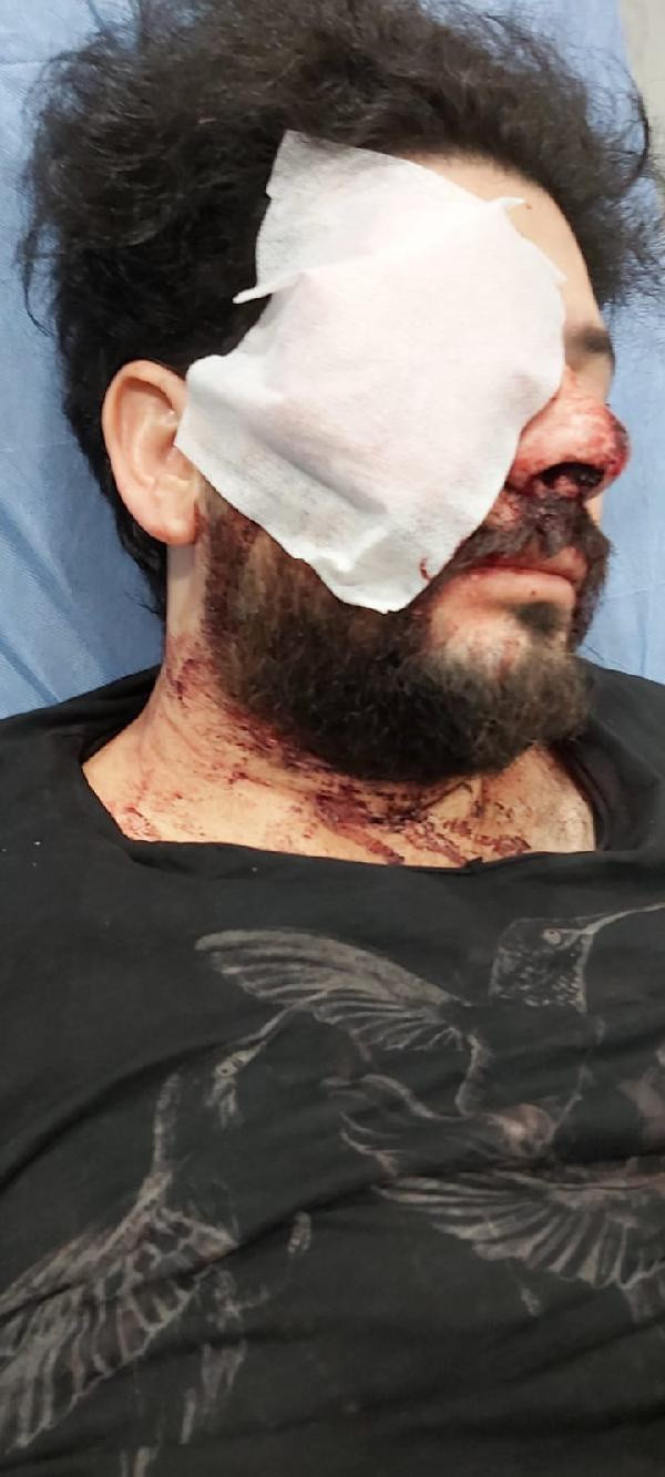 Maganda kuruşunuyla gözünü kaybeden Şahan Dinç dehşet anlarını anlattı - Resim: 0