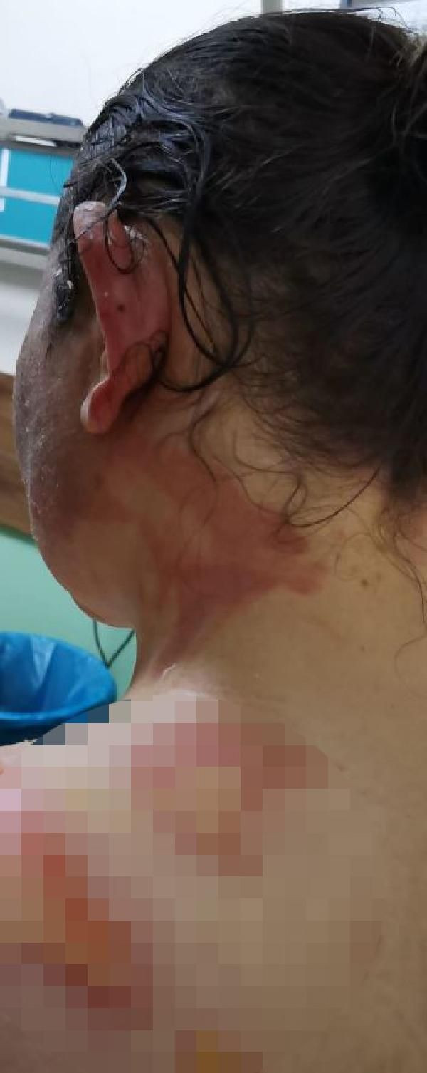 Diyarbakır'da dehşet! Çocuklarının gözü önünde eşini kızgın yağ ve kaynar su ile haşladı - Resim: 4