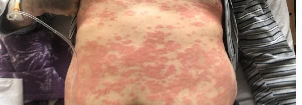 Cerrahpaşa'da çekildi! Derideki kızarıklık, kurdeşen ve kaşıntı koronavirüs belirtisi mi? - Resim: 3