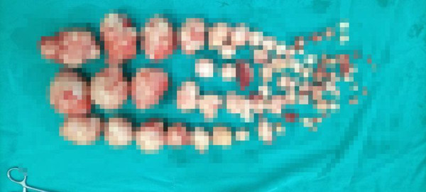 Malatya'da karın ağrısıyla hastaneye gitti! Doktor şok oldu: 72 tane çıktı - Resim: 0