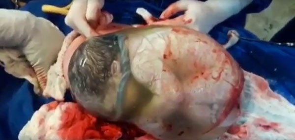 Bebek bu halde dünyaya geldi doktorlar şoke oldu - Resim: 1