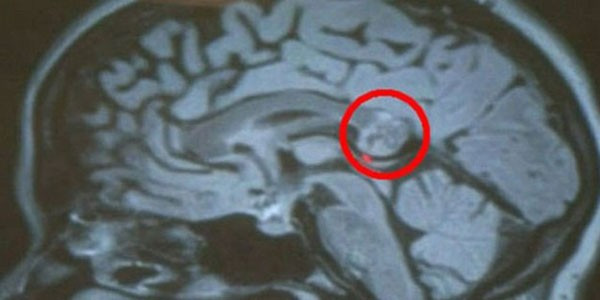 Beyninden kardeşi çıktı! Tıp dünyası şokta - Resim: 4