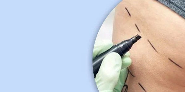 İstanbul'da estetik skandalı! Brezilya poposu istedi ölümden döndü - Resim: 4